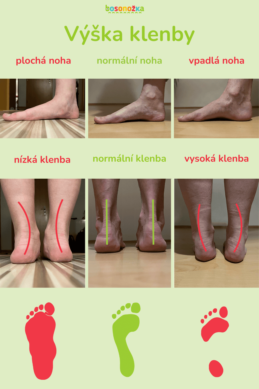 plochá chodida - výška klenby